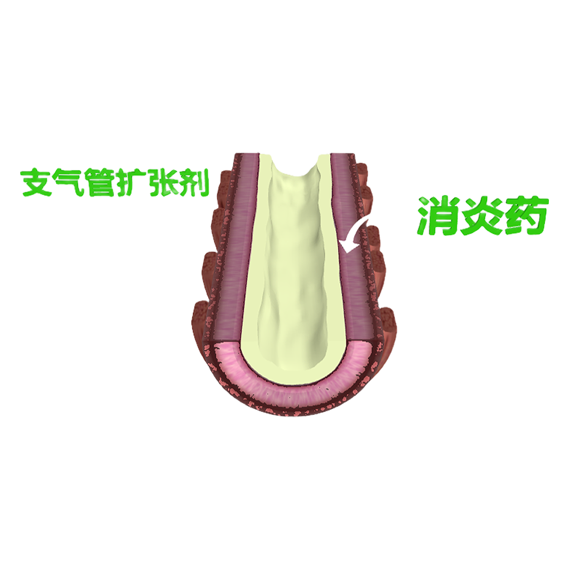 支气管炎症的治疗过程（3D演示动画） | 3D动画,治疗过程,治疗过程演示动画,演示动画,支气管炎,医疗演示动画,演示动画3D模型,3D模型,3D打印,3D素材,obj,glTF,fbx,dae,stl,3ds,glb,usdz,3dmax,blender模型,VisionPro,3D建模,3D扫描,3d打印模型