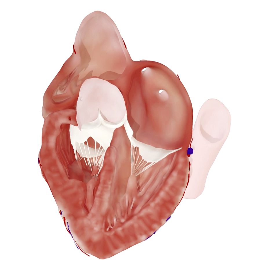 先天性法洛四联症（心腔视图）病理模型 | 医学3D模型,医学模型,医学科普,病理模型,心脏模型,先天性心脏病,先天性法洛四联症,法洛四联症,3D模型,3D打印,3D素材,obj,glTF,fbx,dae,stl,3ds,glb,usdz,3dmax,blender模型,VisionPro,3D建模,3D扫描,3d打印模型